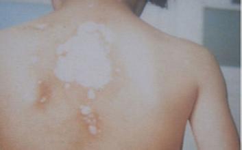 初期白癜风在皮肤上面都表现什么症状