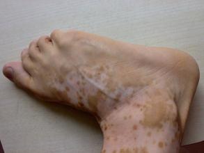肢端型白斑患者的治疗有哪些呢